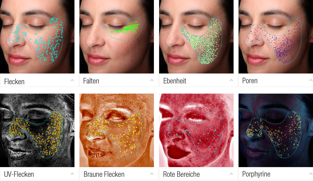 Anzeige und Ergebnisse auf einem Gesicht bei einer 3D-Hautanalyse mit VISIA®